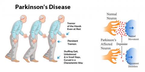 Реферат: Parkinsons Essay Research Paper Parkinson s DiseaseThe